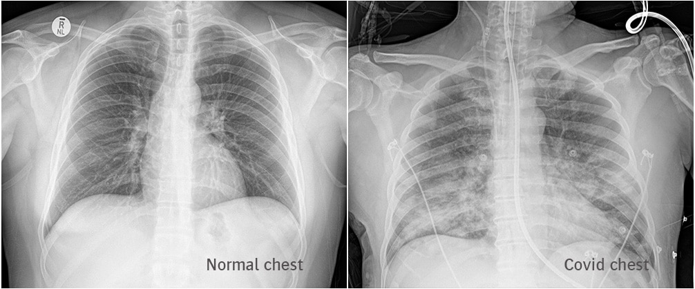 Normal Covid Chest